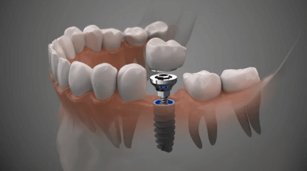 Do You Need Dental Implants?