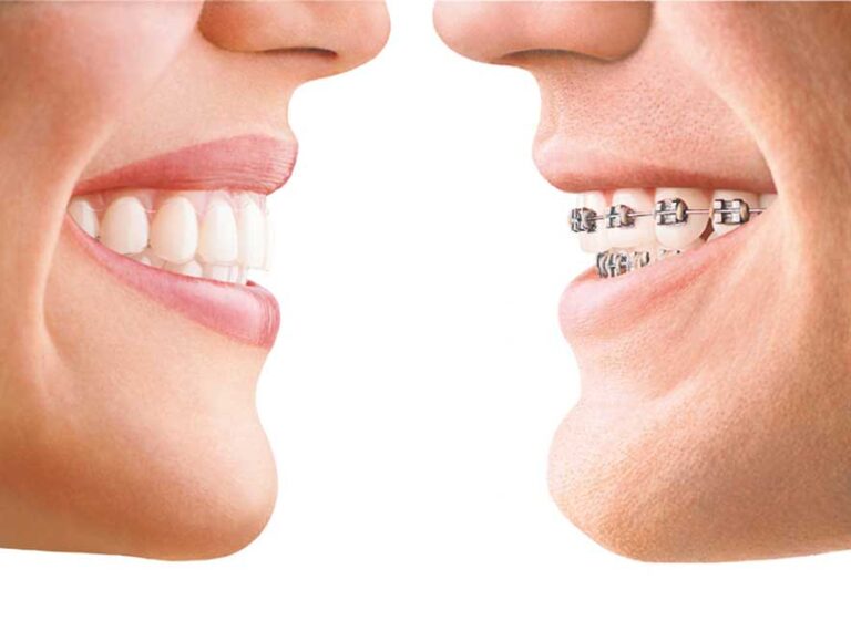 Invisalign vs Braces - Love To Smile