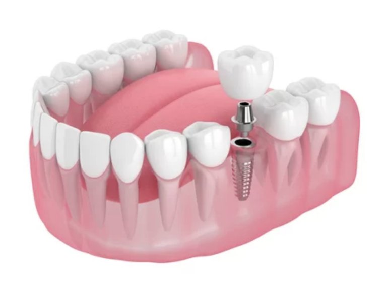 Dental implant example love to smile