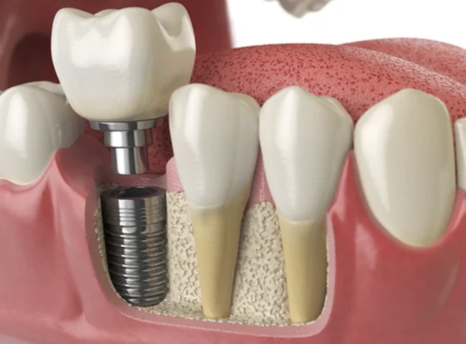 Dental Implant in Tooth