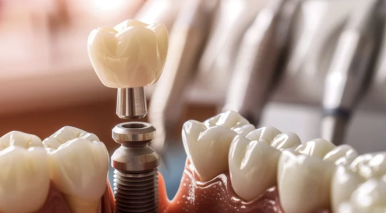 Dental Implants Love To Smile Kansas City