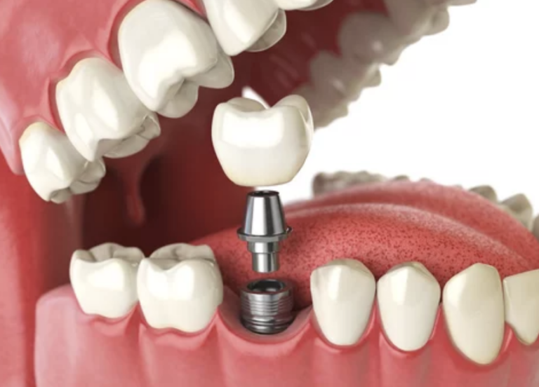 Dental Implants Love To Smile Kansas City