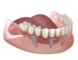 All on four dental implants