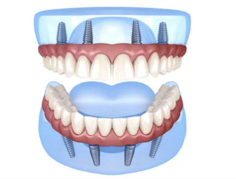 All on four implants diagram