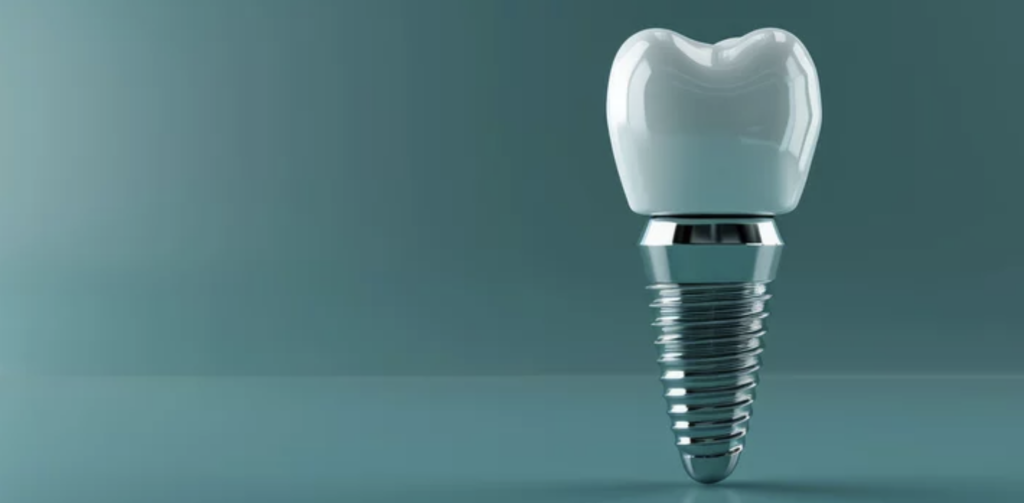 dental implants love to smile kansas city