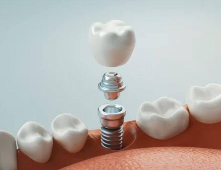 dental implants love to smile kansas city