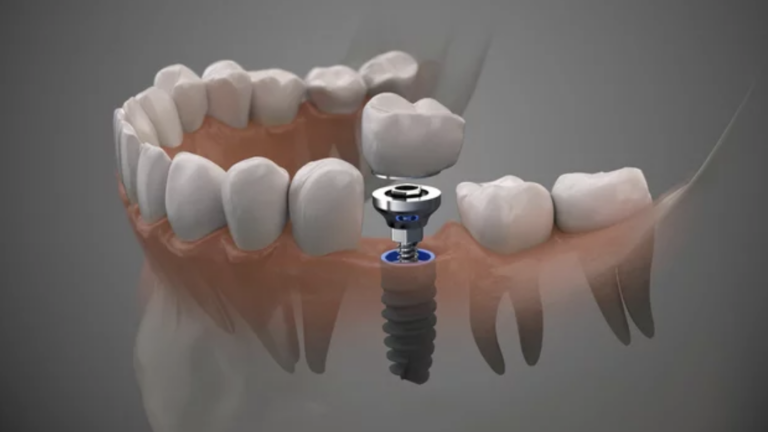 dental implants love to smile kansas city