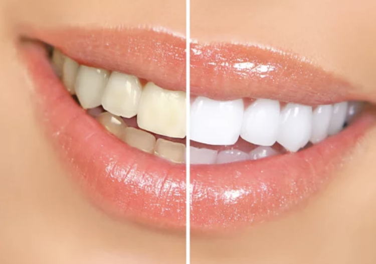 teeth whitening at Love To Smile