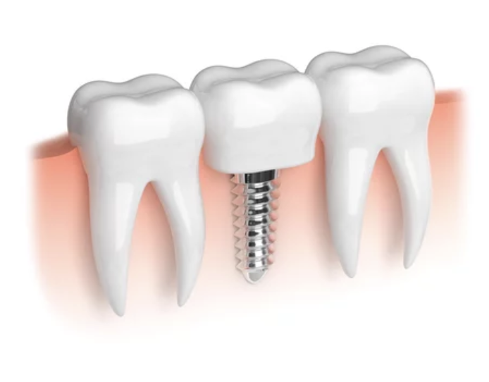 dental implants kansas and missouri