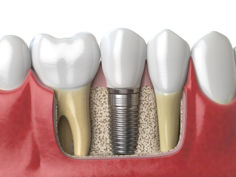 Anatomy of healthy teeth and tooth dental implant in human dentu