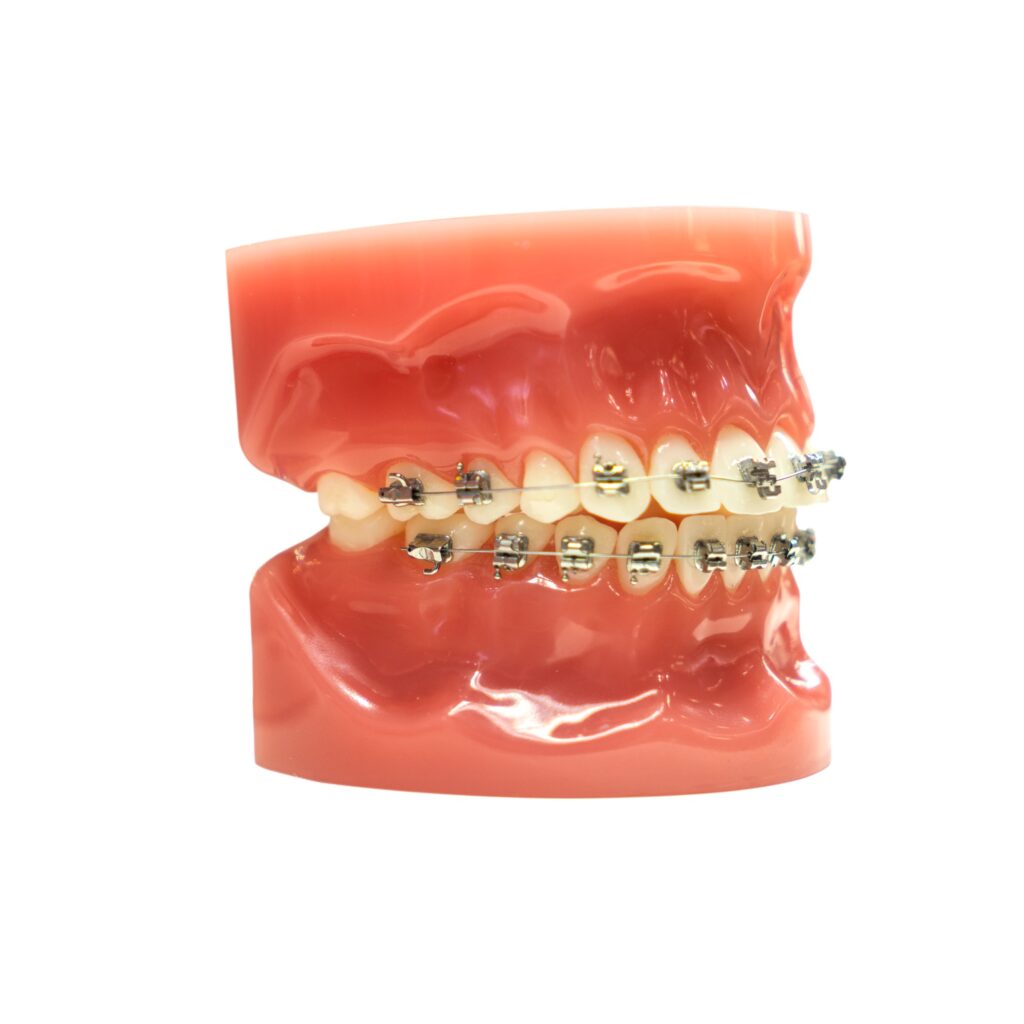 tooth model with metal wire dental braces isolated on white background